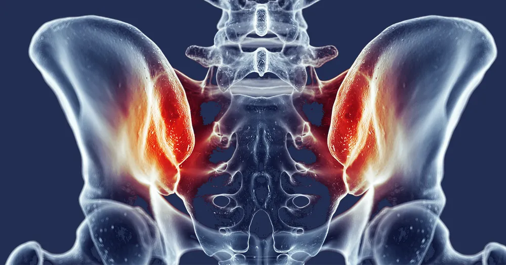 SI Dis-Jointed | Sacroiliac Joint Pain