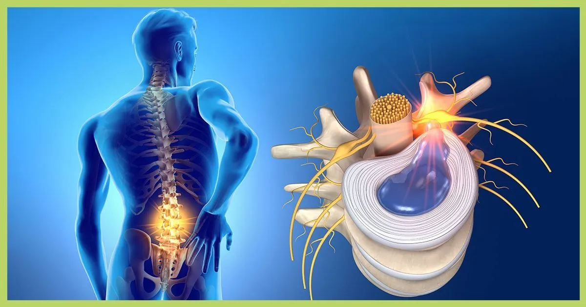 Disc Herniation? We got you