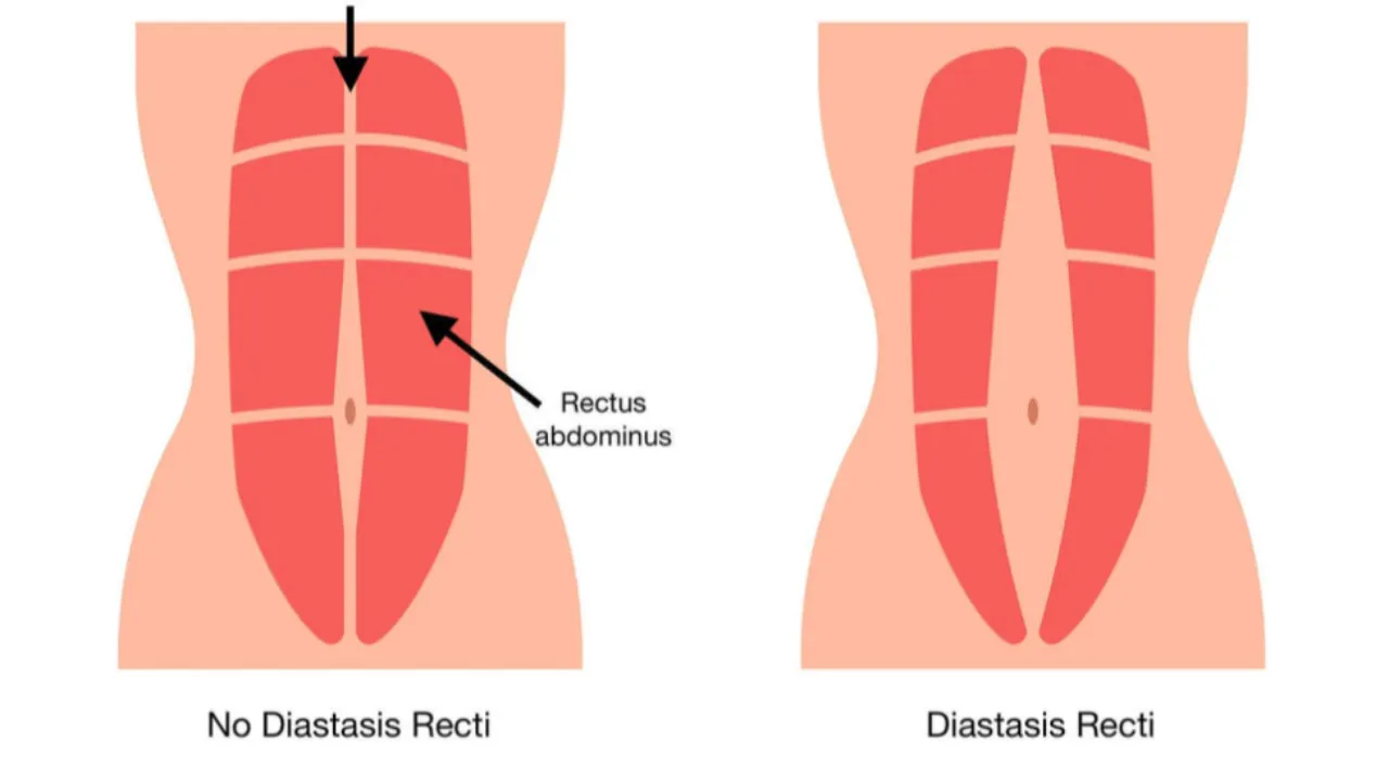 Treating Prolapse with Pelvic Floor Therapy: The Evidence